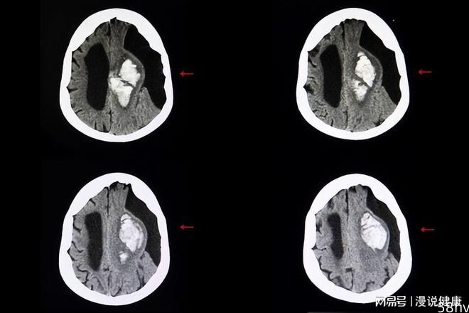 什么样情况下需要警惕“白肺”？对于这4种病，有必要及时照个CT