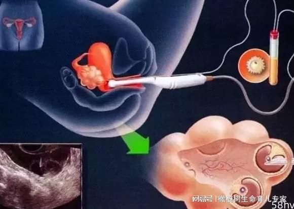 “憋尿”也是门学问？做好这件小事，试管胚胎着床率再上分!