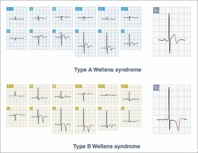 Wellens综合征：病因、诊断和治疗
