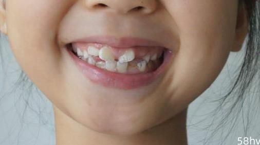 为什么越来越多孩子牙齿不齐？专家提醒：家长要注意这五点！