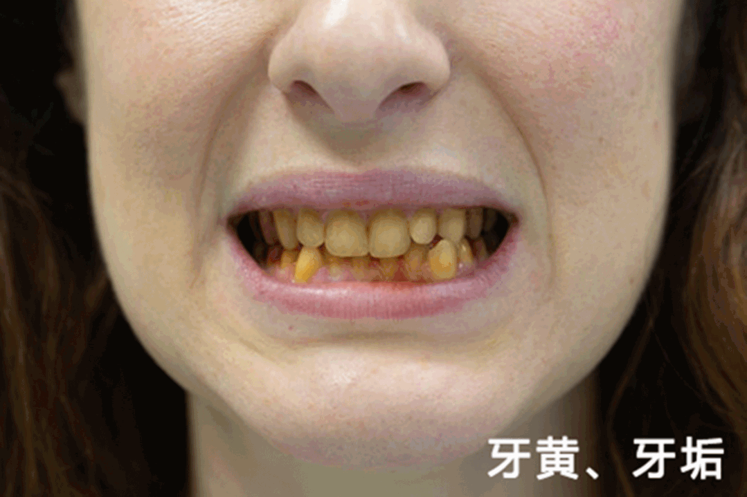 牙黄很尴尬？用牙膏界的“烟酰胺”，一刷亮白， 牙黄牙垢唰唰落